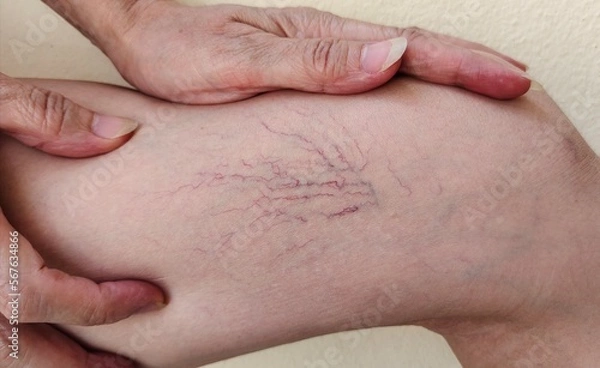 Fototapeta close up the wrinkle and red lines, showing the hand holding the varicose veins and spider on the leg, problem circulation of blood, painful on the knee patient woman, health care and medical concept.