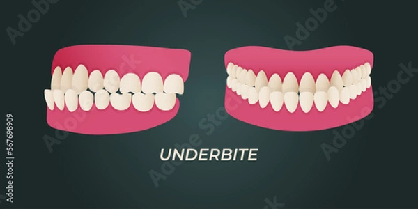 Fototapeta Medical dental diagram illustration. Orthodontist human tooth anatomy. Vector infographics with teeth diagrams.