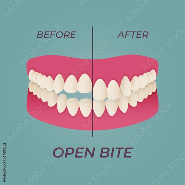 Fototapeta Medical dental diagram illustration. Orthodontist human tooth anatomy. Vector infographics with teeth diagrams.
