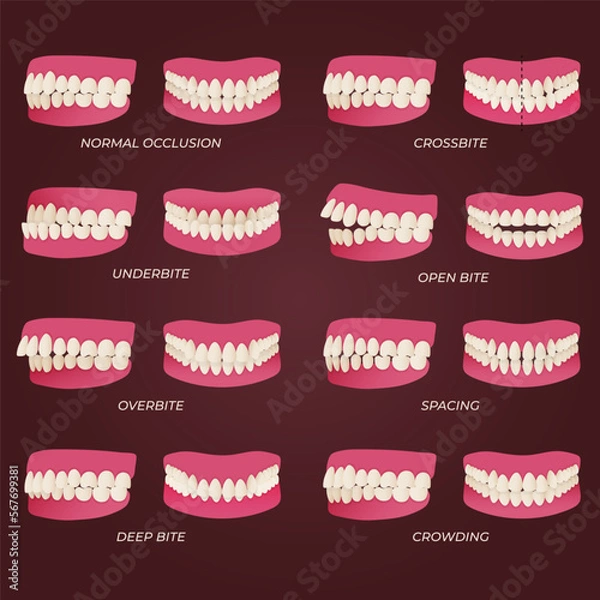 Fototapeta Medical dental diagram illustration. Orthodontist human tooth anatomy. Vector infographics with teeth diagrams.