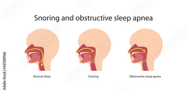 Obraz Snoring and obstructive sleep apnea