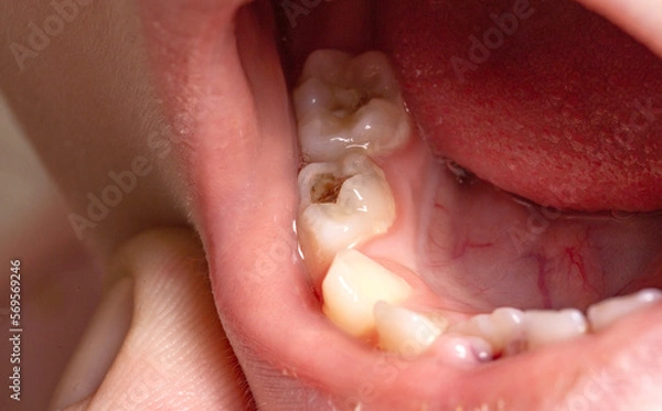 Fototapeta Deep caries in children on milk teeth. Treatment of caries, toothache. Baby teeth, macro