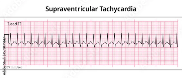 Fototapeta ECG Supraventricular Tachycardia - 8 Second ECG Paper - Electrocardiography Vector Medical Illustration