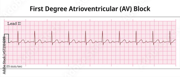 Fototapeta ECG First Degree Atrioventricular Block - 1st degree AV Block - 8 Second ECG Paper - Electrocardiography Vector Medical Illustration