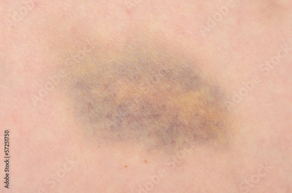 Obraz Bruise