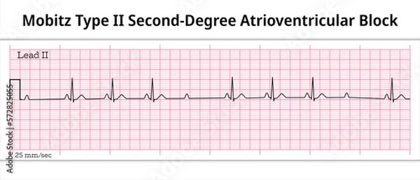 Fototapeta ECG Mobitz Type 2 Second Degree Atrioventricular Block - 2nd degree AV Block - 8 Second ECG Paper - Electrocardiography Vector Medical Illustration