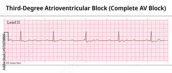 Fototapeta ECG Third Degree Atrioventricular Block - Complete AV Block - 8 Second ECG Paper - Electrocardiography Vector Medical Illustration