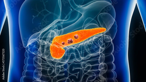 Fototapeta Pancreas or pancreatic cancer with organs and tumors or cancerous cells 3D rendering illustration with male body. Anatomy, oncology, disease, medical, biology, science, healthcare concepts.
