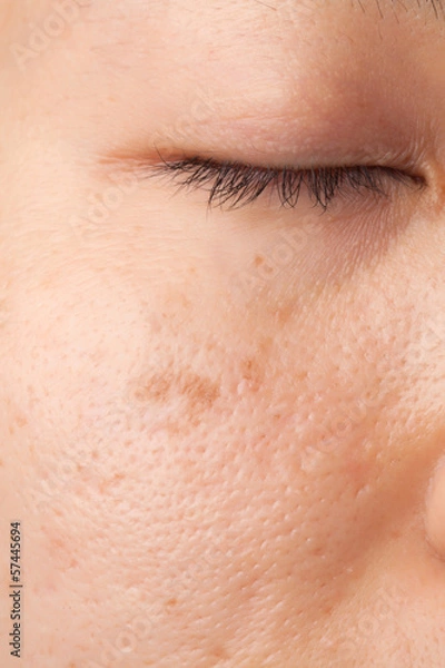 Obraz Scar and skin problem