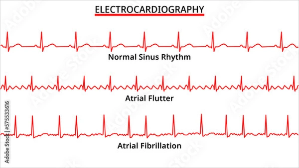 Obraz Set of ECG Common Abnormalities - Atrial Flutter vs Atrial Fibrillation - Normal Sinus Rhythm - Electrocardiography Vector Medical Illustration