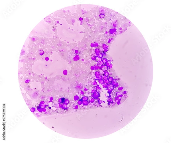 Fototapeta Chronic myeloid leukemia (CML) in accelerated phase with thrombocytosis. Chronic myelogenous leukemia.