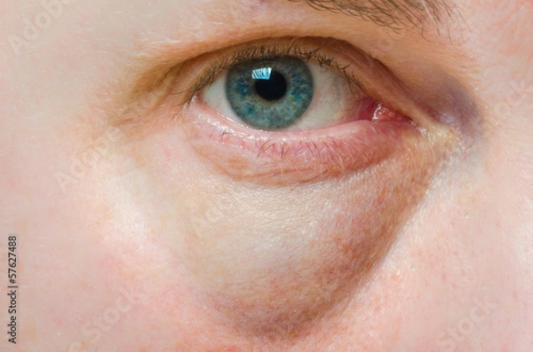 Obraz Puffy swollen eye