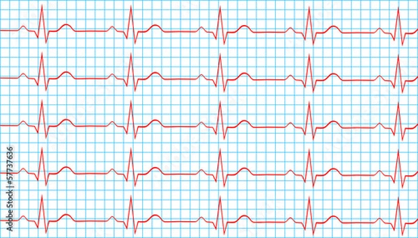 Fototapeta Heart Normal Sinus Rhythm On Electrocardiogram Record
