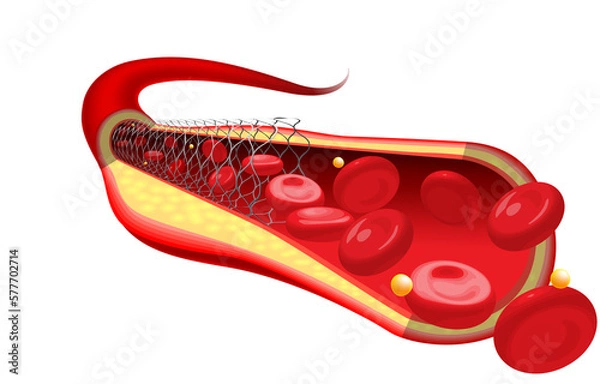 Fototapeta Medical and educational illustrations of the stent are already inserted, improving blood flow.