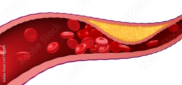 Fototapeta Arteries that are clogged with fat that causes blood clots are a leading cause of death.