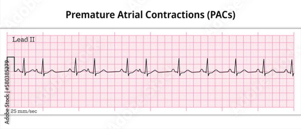 Fototapeta Premature Atrial Contractions (PACs) - Premature Atrial Complex (PAC) - 8 Second ECG Paper - Electrocardiography Vector Medical Illustration