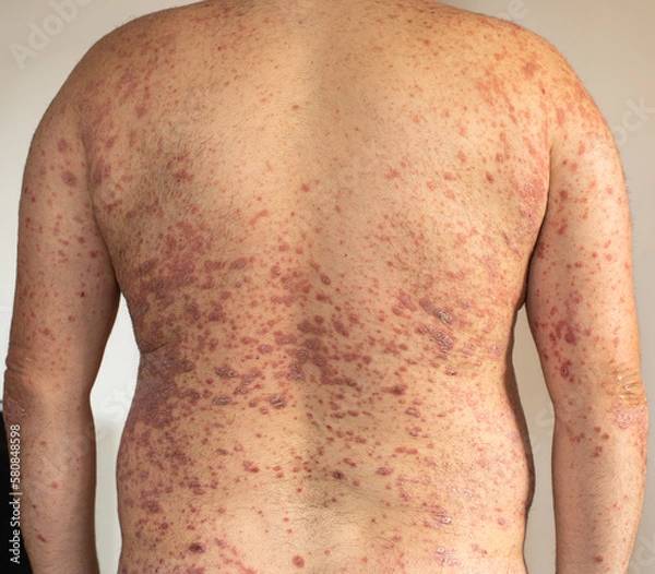 Obraz A man with psoriasis
