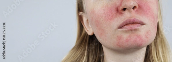 Fototapeta Rosacea face. The girl suffers from redness on her cheeks. Couperosis of the skin. Redness and capillary mesh are visible on the face. Treatment and removal. Vascular surgery and dermatology