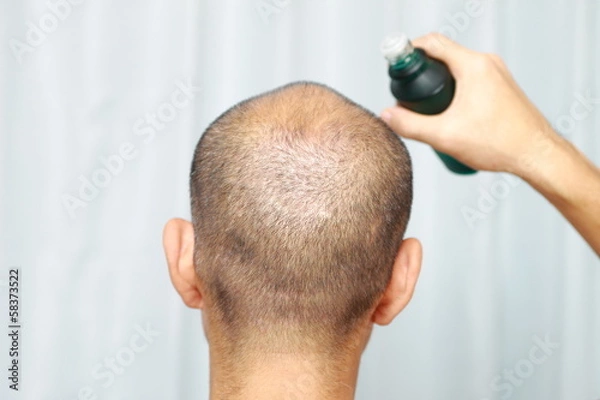 Fototapeta 薄毛の男性