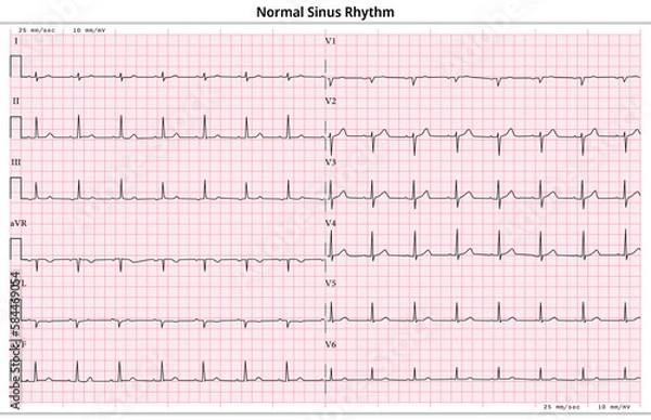 Fototapeta ECG Normal Sinus Rhythm - 12 Lead ECG Common Case - 6 Sec/lead - Vector Medical Illustration