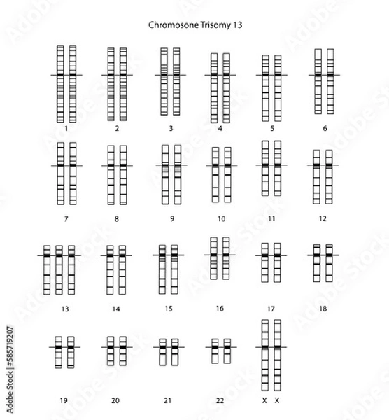 Obraz Chromosome Trisomy 13