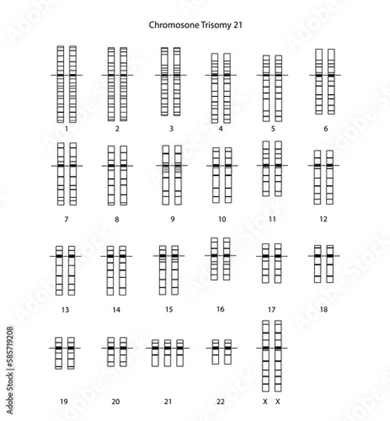 Obraz Chromosome Trisomy 21