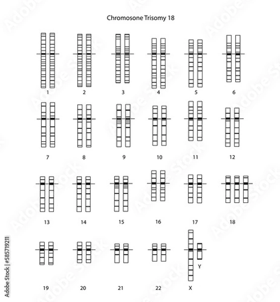 Obraz Chromosome Trisomy 18