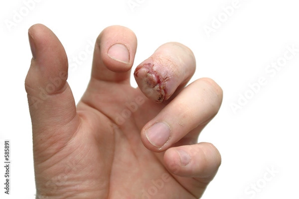 Obraz missing fingernail