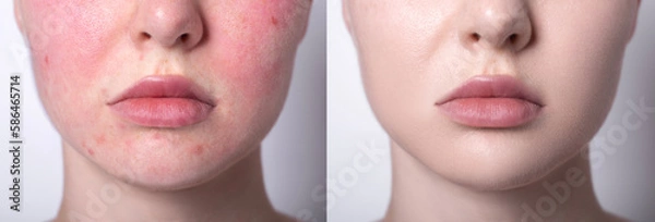 Fototapeta Rosacea couperose redness skin treatment, before and after result of IPL laser treatment, red spots on cheeks, young woman with sensitive skin, patient face close-up