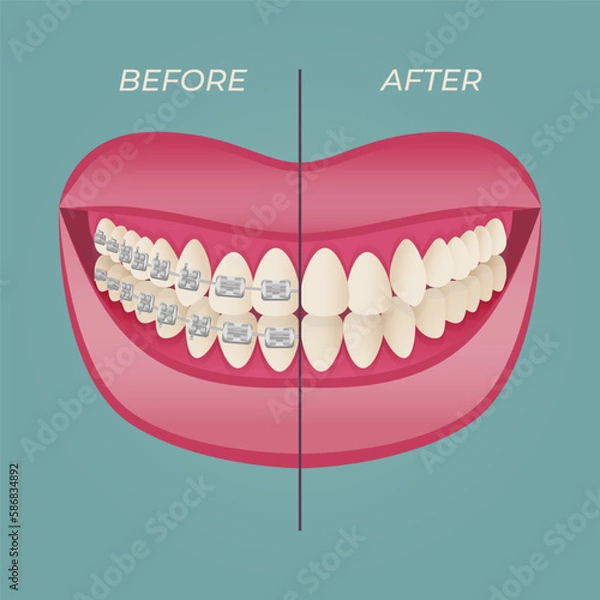Fototapeta The concept of teeth alignment with braces. Orthodontic dentistry. The alignment of the teeth. Beautiful white teeth. Isolated flat vector illustration. Simple teeth in a row. Orthodontic treatment.