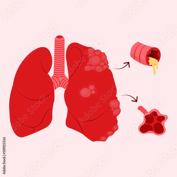 Fototapeta Illustration of a diseased lung affected by COPD (Chronic Obstructive Pulmonary Disease), perfect for medical presentations or educational materials.