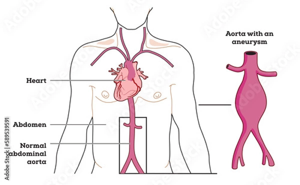 Fototapeta Location and appearance of an abdominal aortic aneurysm