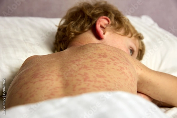 Fototapeta Sad boy lies on the bed in the room, his whole body covered with red allergic spots. A small child has a hard time tolerating chickenpox, the whole body is in a red rash