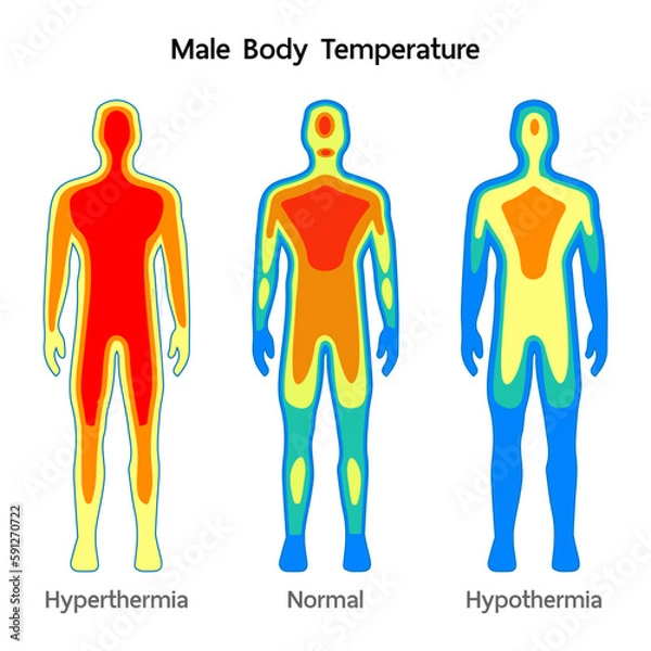 Obraz Male body Temperature model Normal, Hyperthermia and hypothermia health care infographic. Vector flat healthcare illustration. Body cooling infrared heat map isolated on white background.
