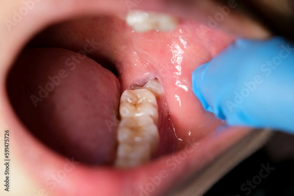 Obraz Wisdom teeth affect and cause gum recession.