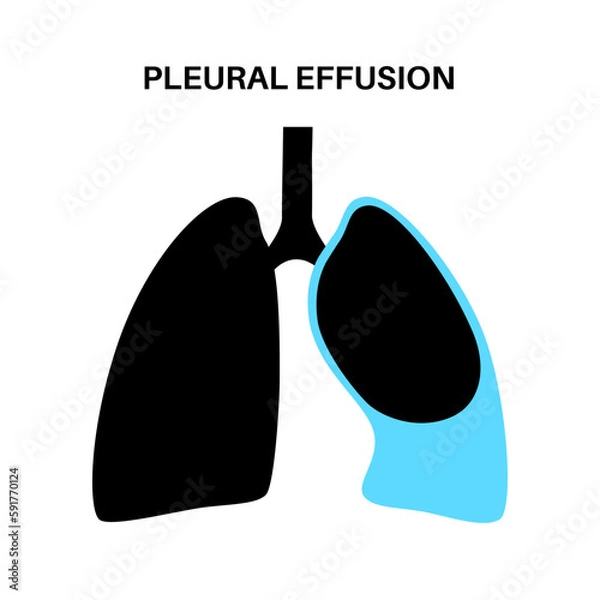 Fototapeta Pleural effusion poster