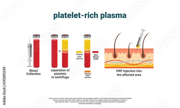 Fototapeta Platelet-Rich plasma procedure stages / prp / Centrifuge vector