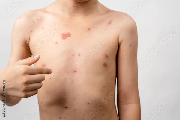 Obraz A 7 year old Asian boy has chickenpox. pimples on the body of child with chickenpox