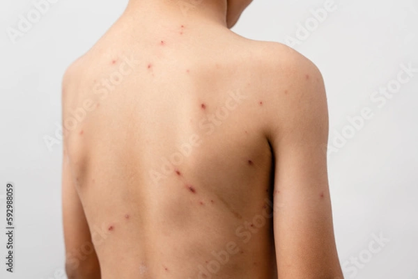 Fototapeta A 7 year old Asian boy has chickenpox. pimples on the body of child with chickenpox