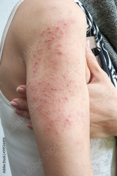 Obraz allergic rash dermatitis