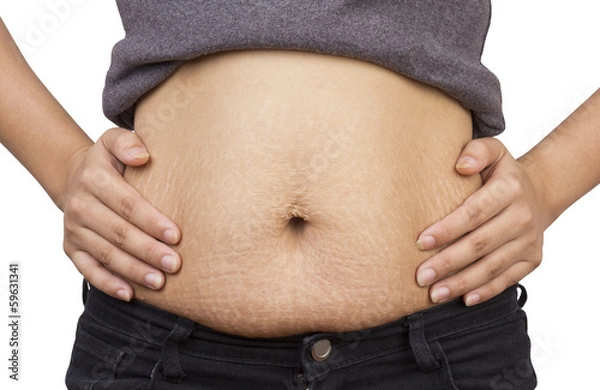 Obraz Stretch Marks