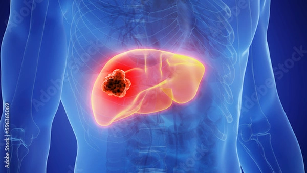 Obraz 3D Rendered Medical Illustration of Male Anatomy - liver cancer
