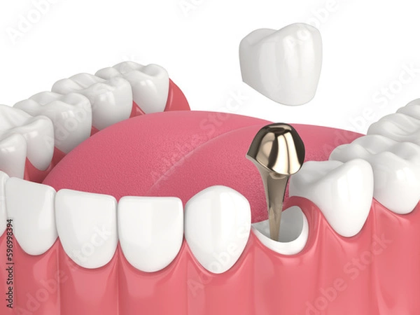 Fototapeta 3d render of lower jaw with cast post and core tooth restoration