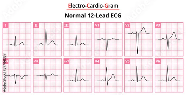 Fototapeta The Differences in Normal ECG Waveform for Each of the 12 Leads Standard ECG - Medical Vectors and Illustrations for Medical Purposes