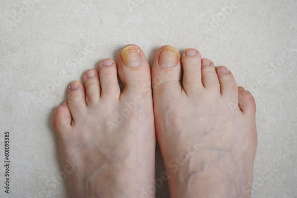Obraz Toenails affected by fungal infection. Onychomycosis