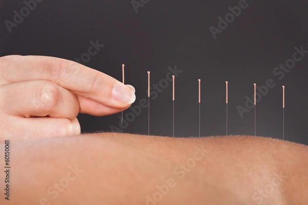 Obraz Leczenie akupunktury