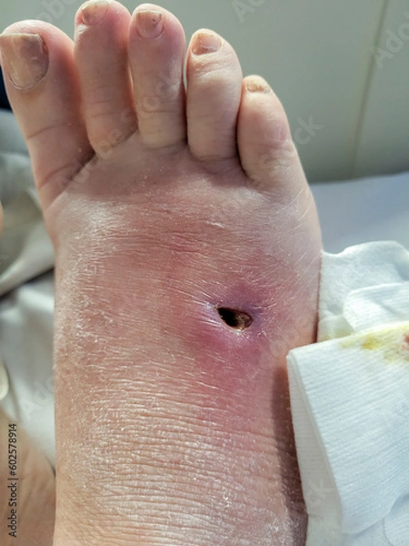 Obraz Stingray whip injury resulting in infection and tissue necrosis.  Requiring surgical removal of an imbedded stingray barb and debridement. The infection would also require strong broad-spectrum antibi