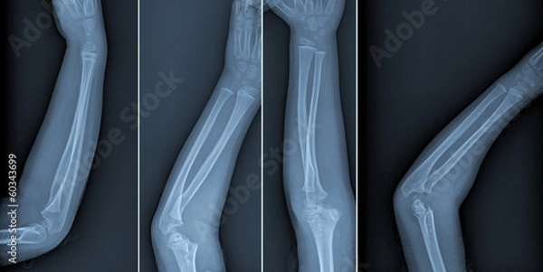 Obraz Broken arm xray