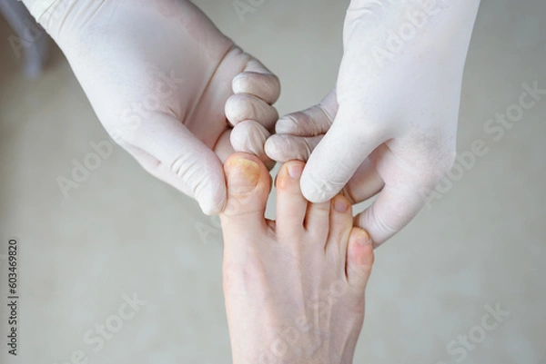 Obraz Onychomycosis. Foots with fungus on nails is examined by doctor in gloves