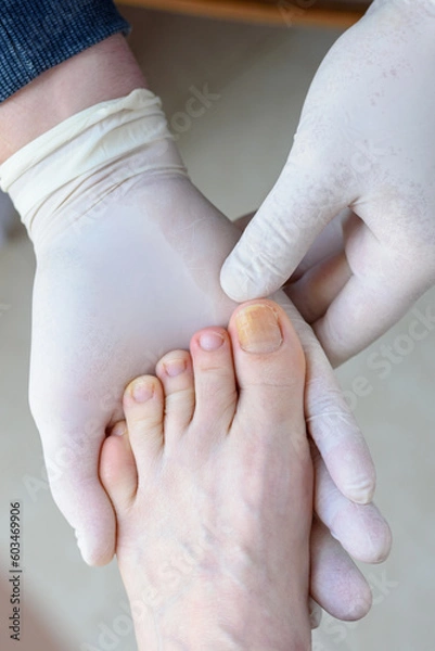 Obraz Onychomycosis. Foots with fungus on nails is examined by doctor in gloves